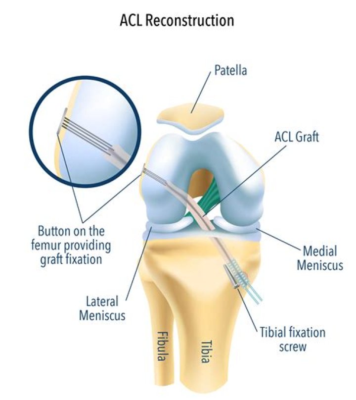 Are repaired ACL stronger?