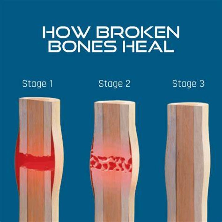 Do calcium pills help heal broken bones?