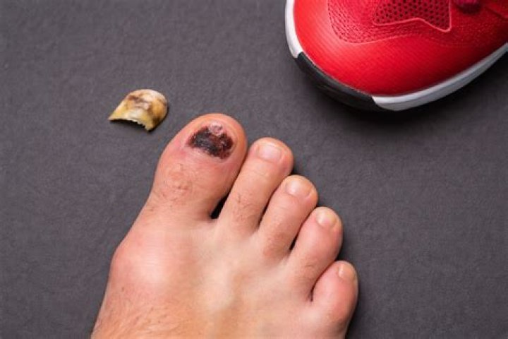 How do I stop my toenail from throbbing?