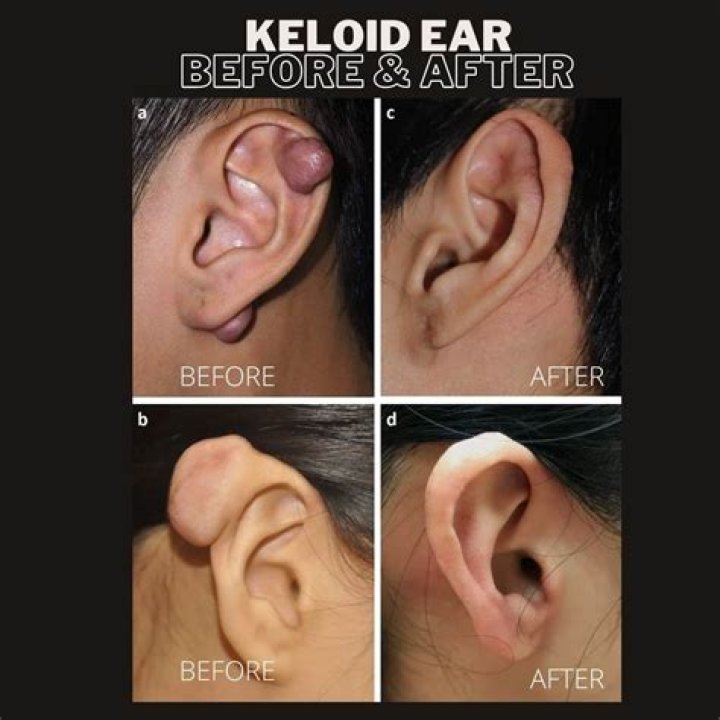 What is the most effective treatment for keloids?