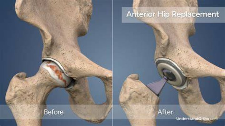 When can I have a shower after hip replacement?